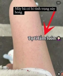 sua tam tri mun lung ADERMA 4