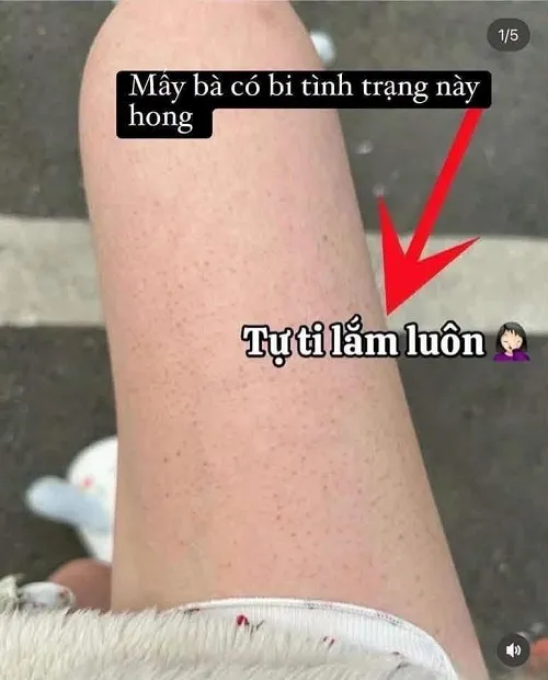 sua tam tri mun lung ADERMA 4
